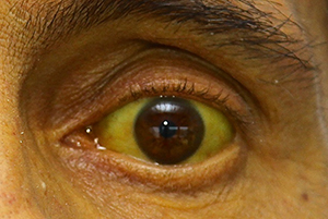 Photographie couleur : Coloration jaune du fond de l'oeil caractéristique d'un ictère. Hopital Paul-Brousse, 2015