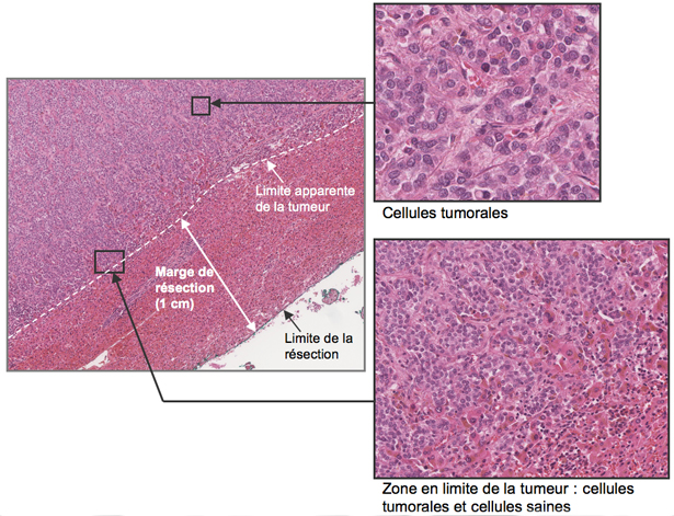 Coupes histologiques en couleur montrant la limite de résection d'une métastase hépatique de cancer du sein.